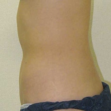 腹部・腰のafter写真