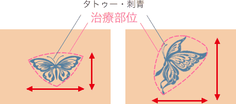 タトゥーの治療部位の違いイメージ図