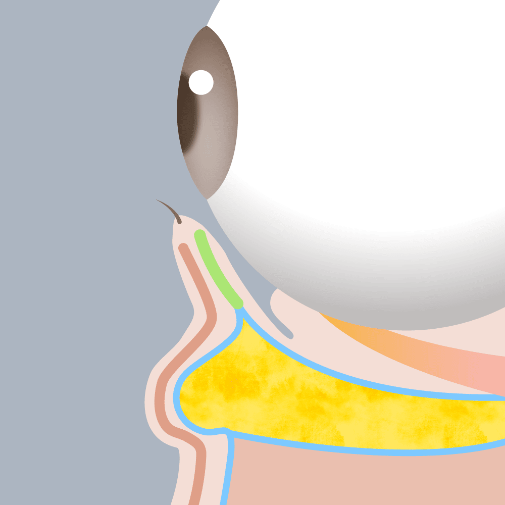 下眼瞼脱脂の図解