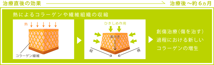 サーマクール治療前後の図解