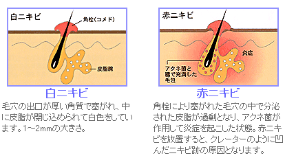 ニキビの状態に関するイメージ図